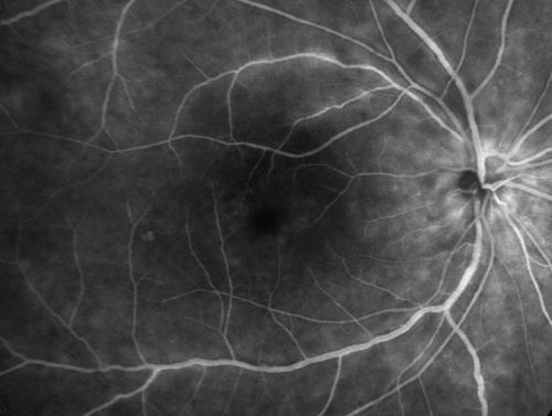 Birdshot Chorioretintis and PAMM
Patient presented with paracentral acute middle maculopathy as the presenting symptom of birdshot.  This case was published. RETINAL CASES & BRIEF REPORTS 10:151â€“153, 2016.
