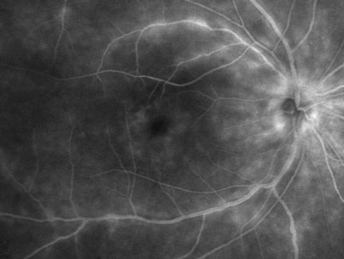 Birdshot Chorioretintis and PAMM
Patient presented with paracentral acute middle maculopathy as the presenting symptom of birdshot.  This case was published. RETINAL CASES & BRIEF REPORTS 10:151â€“153, 2016.
