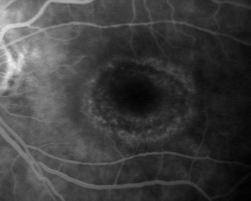 Plaquenil Toxicity with New Symptomatic Scotoma Left Eye
64-year-old female decreased vision OS over the past 2 months. She describes a blurred central scotoma. She has rheumatoid arthritis and is on Plaquenil 200 mg BID for 15 years. She does have yearly visual field tests done with last visual field test performed 3 years ago which was within normal limits OD 20/40-2 OS 20/40-1
