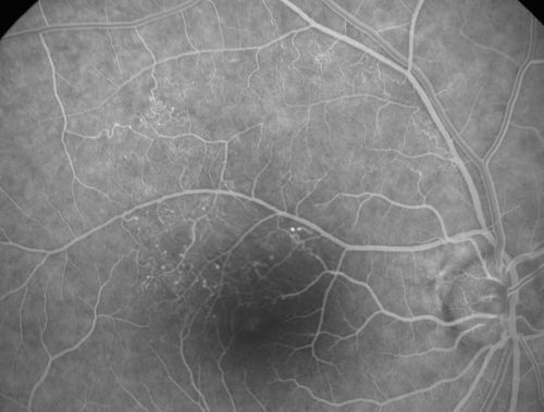 BRVO with collaterals and cystoid macular edema
66 Year Old Man with has had a branch retinal vein occlusion in the right eye with vision loss for the last few months.  OD is 20/40, OS is 20/20.  IOP:  OD 18, OS 19.  There is a superotemporal macular branch retinal vein occlusion with edema, hemorrhage, and exudate.
OCT SCAN:  The right eye shows edema with a central foveal thickness of 354 microns FA: shows remodeling of the superotemporal vasculature.  There are already venous-venous collaterals, suggesting the vein occlusion may be a little more than a few months old.  There are multiple microaneurysms superotemporal to the fovea, and there is leakage in the late frames involving the fovea.

Keywords: brvo;cme;cystoid macular edema;collaterals