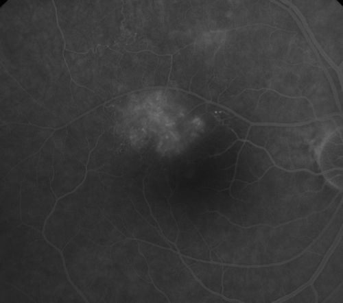 BRVO with collaterals and cystoid macular edema
66 Year Old Man with has had a branch retinal vein occlusion in the right eye with vision loss for the last few months.  OD is 20/40, OS is 20/20.  IOP:  OD 18, OS 19.  There is a superotemporal macular branch retinal vein occlusion with edema, hemorrhage, and exudate.
OCT SCAN:  The right eye shows edema with a central foveal thickness of 354 microns FA: shows remodeling of the superotemporal vasculature.  There are already venous-venous collaterals, suggesting the vein occlusion may be a little more than a few months old.  There are multiple microaneurysms superotemporal to the fovea, and there is leakage in the late frames involving the fovea.

Keywords: brvo;cme;cystoid macular edema;collaterals