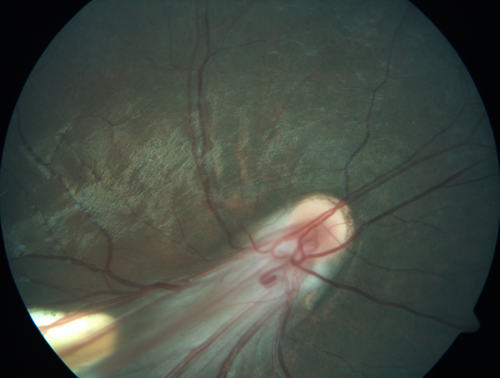 Familial Exudative Vitreoretinopathy - FEVR - Stage 4b OD
10 year old child with poor vision OD from birth.  The left eye had vascular remodelling in the temporal periphery with preretinal abnormalitlies seen on OCT.  The patient never returned for a fluorescein angiogram.  Left eye is either stage 1 or stage 2. no family history
