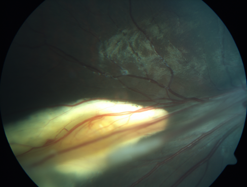 Familial Exudative Vitreoretinopathy - FEVR - Stage 4b OD
10 year old child with poor vision OD from birth.  The left eye had vascular remodelling in the temporal periphery with preretinal abnormalitlies seen on OCT.  The patient never returned for a fluorescein angiogram.  Left eye is either stage 1 or stage 2. no family history
