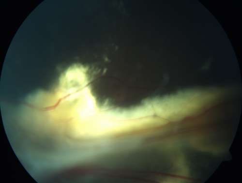 Familial Exudative Vitreoretinopathy - FEVR - Stage 4b OD
10 year old child with poor vision OD from birth.  The left eye had vascular remodelling in the temporal periphery with preretinal abnormalitlies seen on OCT.  The patient never returned for a fluorescein angiogram.  Left eye is either stage 1 or stage 2. no family history
