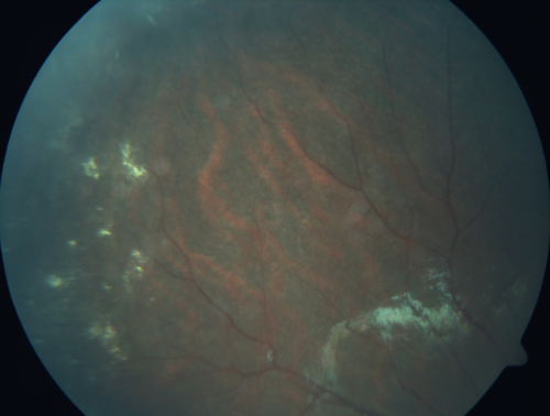 Familial Exudative Vitreoretinopathy - FEVR - Stage 4b OD
10 year old child with poor vision OD from birth.  The left eye had vascular remodelling in the temporal periphery with preretinal abnormalitlies seen on OCT.  The patient never returned for a fluorescein angiogram.  Left eye is either stage 1 or stage 2. no family history
