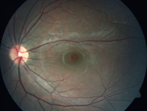 Familial Exudative Vitreoretinopathy - FEVR - Stage 4b OD
10 year old child with poor vision OD from birth.  The left eye had vascular remodelling in the temporal periphery with preretinal abnormalitlies seen on OCT.  The patient never returned for a fluorescein angiogram.  Left eye is either stage 1 or stage 2. no family history
