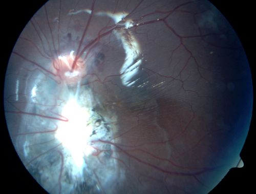 Shotgun wound to face with Perforating Pellet - Final Vision 20/400 
18-year-old had a gunshot wound to the left eye.  He had surgery on December 31st (1 week post injury) and February 4th and his vision has remarkably done well.

VISUAL ACUITY:  Vision OS is 3/200.  
Keywords: choroidal rupture;trauma