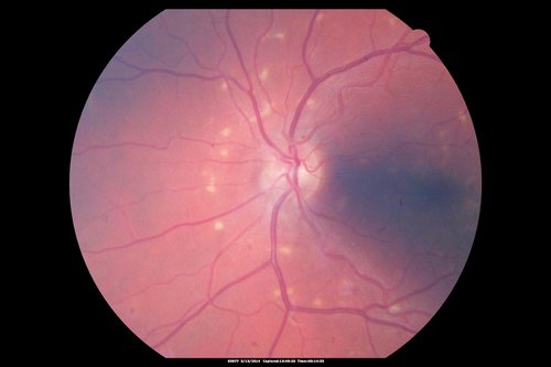 Fundus Flavimaculatus - Asymptomatic - Color Photo
45 year old man was told to come in because of â€˜white spots on their retinaâ€™.

