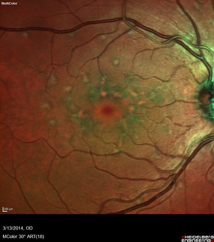 Fundus Flavimaculatus - Asymptomatic - Multi-Color (false color) Photo
45 year old man was told to come in because of â€˜white spots on their retinaâ€™.


