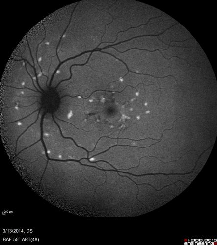 Fundus Flavimaculatus - Asymptomatic - Fundus Autofluorescence
45 year old man was told to come in because of â€˜white spots on their retinaâ€™. - FAF image shows that spots are strongly autofluorescent


