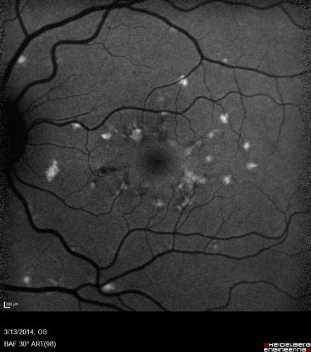 Fundus Flavimaculatus - Asymptomatic - Fundus Autofluorescence
45 year old man was told to come in because of â€˜white spots on their retinaâ€™. - FAF image shows that spots are strongly autofluorescent

