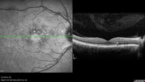 Fundus Flavimaculatus - Asymptomatic
45 year old man was told to come in because of â€˜white spots on their retinaâ€™.

