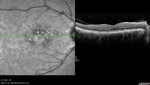 Fundus Flavimaculatus - Asymptomatic - Spectral Domain OCT Line Scan
45 year old man was told to come in because of â€˜white spots on their retinaâ€™.

