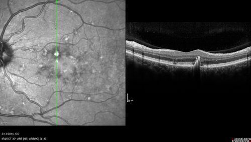 Fundus Flavimaculatus - Asymptomatic - Spectral Domain OCT Line Scan
45 year old man was told to come in because of â€˜white spots on their retinaâ€™.

