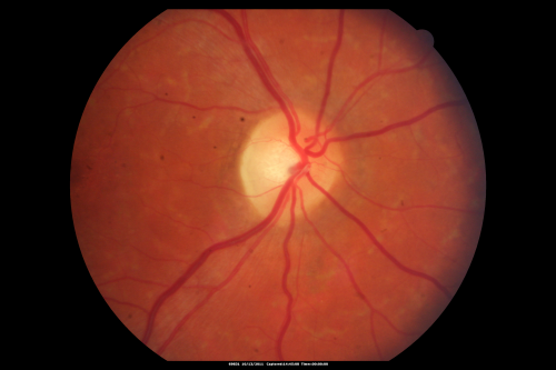 Fundus Flavimaculatus - Stargardt Disease - 20/50 OD 20/200 OS 61 Year old  Color Photo
61-year-old decreasing vision for about the last five years.  OD 20/50,  OS 20/200. 

Pisciform Lesions and Macular Atrophy
