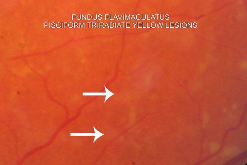 Fundus Flavimaculatus - Stargardt Disease - 20/50 OD 20/200 OS 61 Year old  Color Photo
61-year-old decreasing vision for about the last five years.  OD 20/50,  OS 20/200. 

Pisciform Lesions and Macular Atrophy
