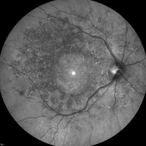 Fundus Flavimaculatus - Stargardt Disease - 20/50 OD 20/200 OS 61 Year old Infrared Image OD
61-year-old decreasing vision for about the last five years.  OD 20/50,  OS 20/200. 

Pisciform Lesions and Macular Atrophy
