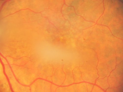 Dense Vitreous Floater (opacity) from Vitreous Separation 
71-year-old woman with a lamellar macular hole in the left eye and also a dense vision floater in the left eye.    OD 20/30, OS 20/25
