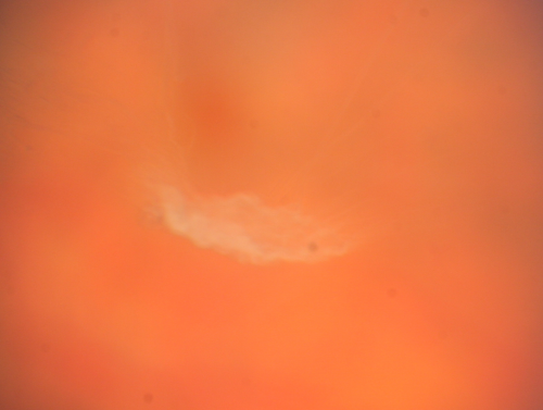 Dense Vitreous Floater (opacity) from Vitreous Separation 
71-year-old woman with a lamellar macular hole in the left eye and also a dense vision floater in the left eye.    OD 20/30, OS 20/25
