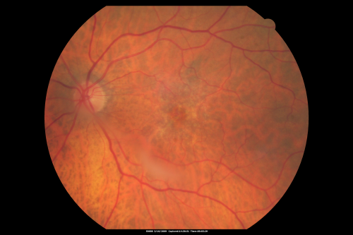 Dense Vitreous Floater (opacity) from Vitreous Separation 
71-year-old woman with a lamellar macular hole in the left eye and also a dense vision floater in the left eye.    OD 20/30, OS 20/25
