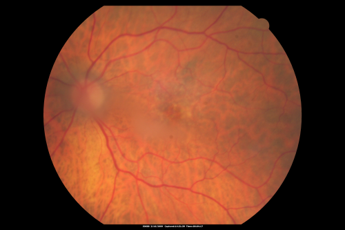 Dense Vitreous Floater (opacity) from Vitreous Separation 
71-year-old woman with a lamellar macular hole in the left eye and also a dense vision floater in the left eye.    OD 20/30, OS 20/25
