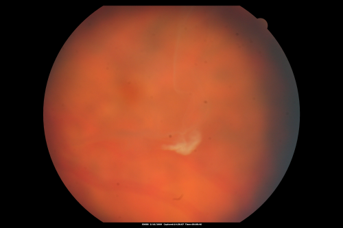 Dense Vitreous Floater (opacity) from Vitreous Separation 
71-year-old woman with a lamellar macular hole in the left eye and also a dense vision floater in the left eye.    OD 20/30, OS 20/25
