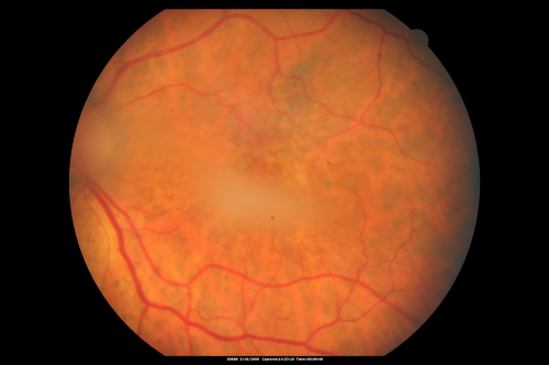 Dense Vitreous Floater (opacity) from Vitreous Separation 
71-year-old woman with a lamellar macular hole in the left eye and also a dense vision floater in the left eye.    OD 20/30, OS 20/25
