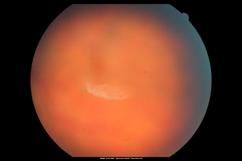 Dense Vitreous Floater (opacity) from Vitreous Separation 
71-year-old woman with a lamellar macular hole in the left eye and also a dense vision floater in the left eye.    OD 20/30, OS 20/25
