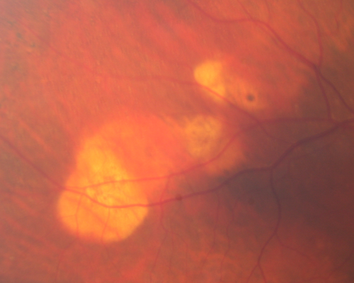Sclerochoroidal Calcification - 72 Year Old Woman 
72-year-old woman who has spots on her lungs, which she has been told are scar tissue 20/30 OU
