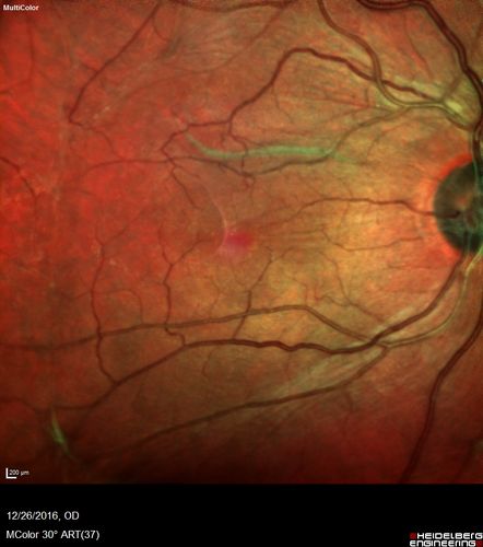 Retinal fold following removal of severe macular pucker
75 year old man had macula on inferior retinal detachment repair.  He then developed a 5/200 dense macular pucker.  After the pucker was removed the vision returned to 20/40 but there was a persistent superior retinal fold that looks a little like a snake.
