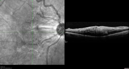 Retinal fold following removal of severe macular pucker
75 year old man had macula on inferior retinal detachment repair.  He then developed a 5/200 dense macular pucker.  After the pucker was removed the vision returned to 20/40 but there was a persistent superior retinal fold that looks a little like a snake.
