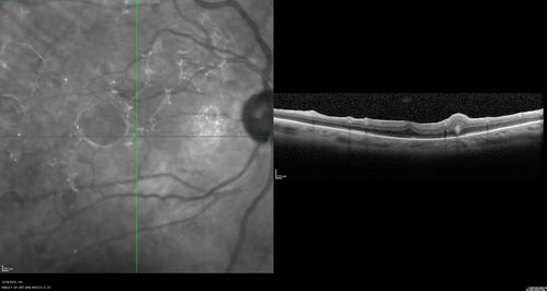 Retinal fold following removal of severe macular pucker
75 year old man had macula on inferior retinal detachment repair.  He then developed a 5/200 dense macular pucker.  After the pucker was removed the vision returned to 20/40 but there was a persistent superior retinal fold that looks a little like a snake.
