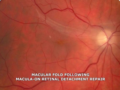 Fresh Macular Fold following Macula On Superior Retinal Detachment Repair
Macular fold after pneumatic retinopexy for macula on superior retinal detachment.  Visual acuity is 20/200
