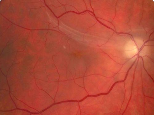 Fresh Macular Fold following Macula On Superior Retinal Detachment Repair
Macular fold after pneumatic retinopexy for macula on superior retinal detachment.  Visual acuity is 20/200
