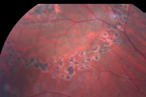 Asymptomatic Laser Demarcated Retinal Detachment has Spontaneously Re-attached 6 Months After Laser
Spontaneously Re-attached Detached Retina

