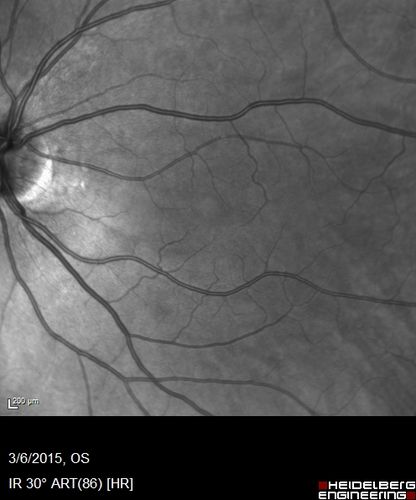 Foveal hypoplasia - aplasia
SD OCT shows persistent plexiform layers in the center of the macula 
EXTENDED HPI: He is having some trouble seeing his gadgets (like his watch). He was diagnosed with morning glory syndrome at about 3 yeras old. This last visit you saw fluid under the retina and asked him to come here. The vision is a little worse.
VA OD: Dcc20/40+2 NccJ2-2
VA OS: Dcc20/25-2 NccJ1-2

