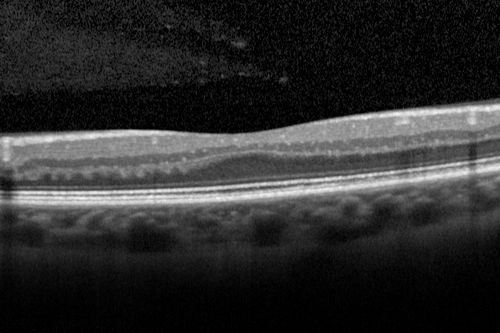 Foveal hypoplasia - aplasia
SD OCT shows persistent plexiform layers in the center of the macula 
EXTENDED HPI: He is having some trouble seeing his gadgets (like his watch). He was diagnosed with morning glory syndrome at about 3 yeras old. This last visit you saw fluid under the retina and asked him to come here. The vision is a little worse.
VA OD: Dcc20/40+2 NccJ2-2
VA OS: Dcc20/25-2 NccJ1-2
