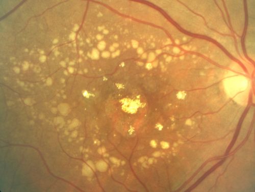 fovealgeographicatrophy_masw01.jpg