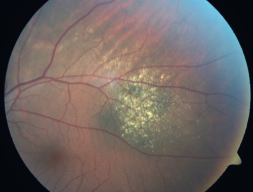 Choroidal Nevus with Overlying Drusen
48-year-old woman Vision OD is 20/16, OS is 20/20.
