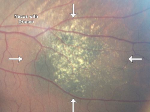 Choroidal Nevus with Overlying Drusen
48-year-old woman Vision OD is 20/16, OS is 20/20.
