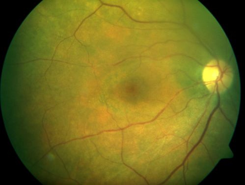 Plaquenil Toxicity with New Symptomatic Scotoma Left Eye
64-year-old female decreased vision OS over the past 2 months. She describes a blurred central scotoma. She has rheumatoid arthritis and is on Plaquenil 200 mg BID for 15 years. She does have yearly visual field tests done with last visual field test performed 3 years ago which was within normal limits OD 20/40-2 OS 20/40-1
