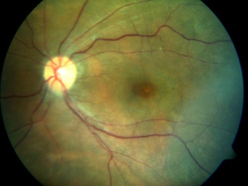 Plaquenil Toxicity with New Symptomatic Scotoma Left Eye
64-year-old female decreased vision OS over the past 2 months. She describes a blurred central scotoma. She has rheumatoid arthritis and is on Plaquenil 200 mg BID for 15 years. She does have yearly visual field tests done with last visual field test performed 3 years ago which was within normal limits OD 20/40-2 OS 20/40-1
