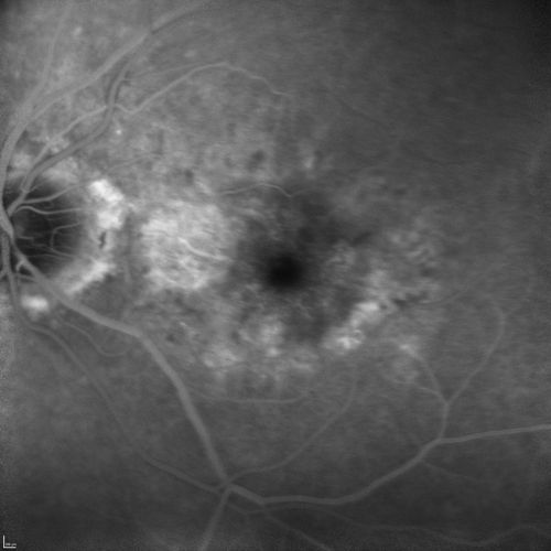 Angioid Streaks and Macular Degeneration - CNVM OS - Band Keratopathy 
79-year-old man has wet age-related macular degeneration in the left eye, for which he is having Lucentis treatment.    OD 20/40,  Pinhole 20/32.   OS 20/160, Pinhole 20/50.   He has band keratopathy sparing the visual axis in both eyes.  ICG shows angioid streaks both eye.
