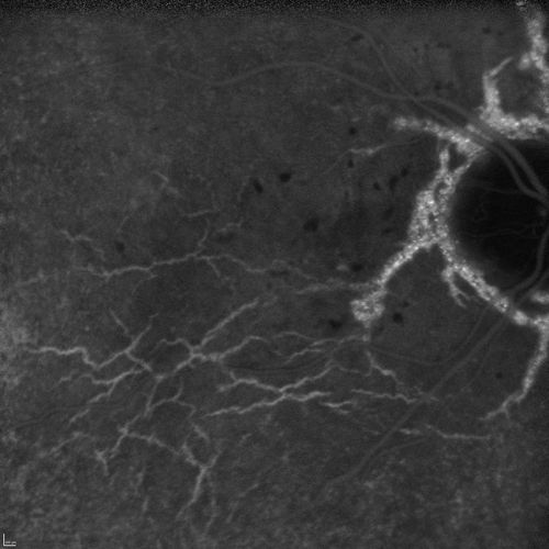 Angioid Streaks and Macular Degeneration - CNVM OS - Band Keratopathy 
79-year-old man has wet age-related macular degeneration in the left eye, for which he is having Lucentis treatment.    OD 20/40,  Pinhole 20/32.   OS 20/160, Pinhole 20/50.   He has band keratopathy sparing the visual axis in both eyes.  ICG shows angioid streaks both eye.
