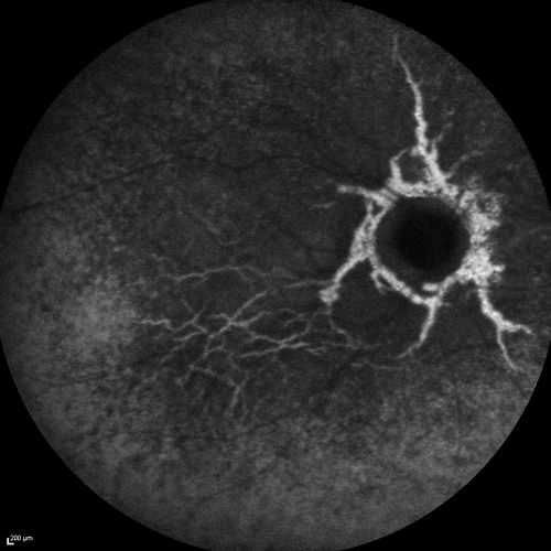 Angioid Streaks and Macular Degeneration - CNVM OS - Band Keratopathy 
79-year-old man has wet age-related macular degeneration in the left eye, for which he is having Lucentis treatment.    OD 20/40,  Pinhole 20/32.   OS 20/160, Pinhole 20/50.   He has band keratopathy sparing the visual axis in both eyes.  ICG shows angioid streaks both eye.
