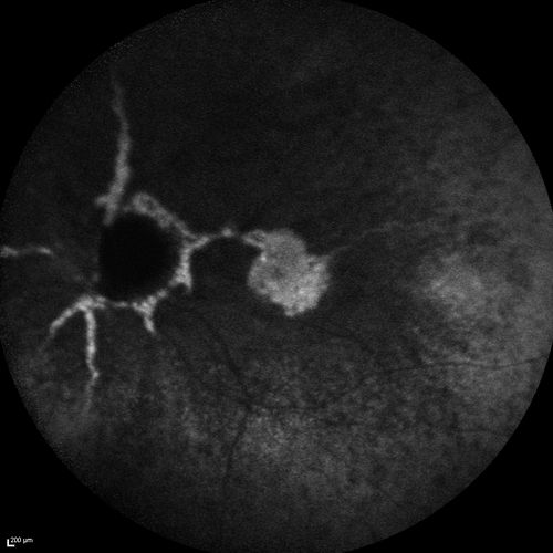 Angioid Streaks and Macular Degeneration - CNVM OS - Band Keratopathy 
79-year-old man has wet age-related macular degeneration in the left eye, for which he is having Lucentis treatment.    OD 20/40,  Pinhole 20/32.   OS 20/160, Pinhole 20/50.   He has band keratopathy sparing the visual axis in both eyes.  ICG shows angioid streaks both eye.
