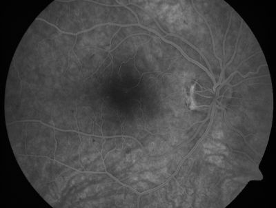 Retinal Vasculopathy associated with Facioscapulohumeral Muscular Dystrophy mid fa
59-year-old woman had a blood pressure spike to 170/90 and was on medications for that. She does have facioscapulohumeral muscular dystrophy, which runs in her family. She has a cousin with the same disorder.
VISUAL ACUITY: Her vision is 20/25 OU. IOP: OD 21, OS 18.
There is no posterior vitreous separation, telangiectatic vessels near the macula. There are patchy retinal hemorrhages. There is no edema or proliferation.

Keywords: diabetic like; systemic disease; vasculopathy; hemorrhage; bdr