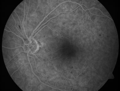 Retinal Vasculopathy associated with Facioscapulohumeral Muscular Dystrophy  mid fa
59-year-old woman had a blood pressure spike to 170/90 and was on medications for that. She does have facioscapulohumeral muscular dystrophy, which runs in her family. She has a cousin with the same disorder.
VISUAL ACUITY: Her vision is 20/25 OU. IOP: OD 21, OS 18.
There is no posterior vitreous separation, telangiectatic vessels near the macula. There are patchy retinal hemorrhages. There is no edema or proliferation.

Keywords: diabetic like; systemic disease; vasculopathy; hemorrhage;