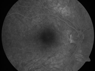 Retinal Vasculopathy associated with Facioscapulohumeral Muscular Dystrophy late fa
59-year-old woman had a blood pressure spike to 170/90 and was on medications for that. She does have facioscapulohumeral muscular dystrophy, which runs in her family. She has a cousin with the same disorder.
VISUAL ACUITY: Her vision is 20/25 OU. IOP: OD 21, OS 18.
There is no posterior vitreous separation, telangiectatic vessels near the macula. There are patchy retinal hemorrhages. There is no edema or proliferation.

Keywords: diabetic like; systemic disease; vasculopathy; hemorrhage; bdr