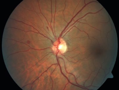 Retinal Vasculopathy associated with Facioscapulohumeral Muscular Dystrophy 
59-year-old woman had a blood pressure spike to 170/90 and was on medications for that. She does have facioscapulohumeral muscular dystrophy, which runs in her family. She has a cousin with the same disorder.
VISUAL ACUITY: Her vision is 20/25 OU. IOP: OD 21, OS 18.
There is no posterior vitreous separation, telangiectatic vessels near the macula. There are patchy retinal hemorrhages. There is no edema or proliferation.

Keywords: diabetic like; systemic disease; vasculopathy; hemorrhage; bdr